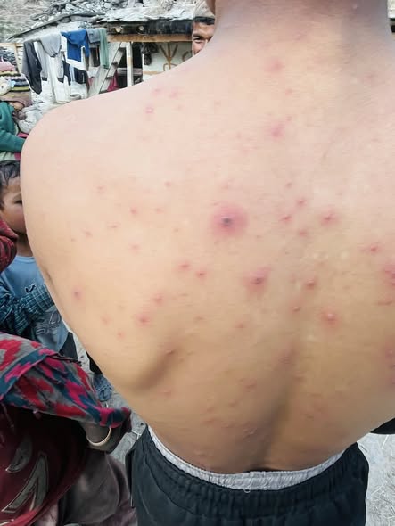 अदानचुलीका ३५ जना ठेउलाका बिरामी भेटिए